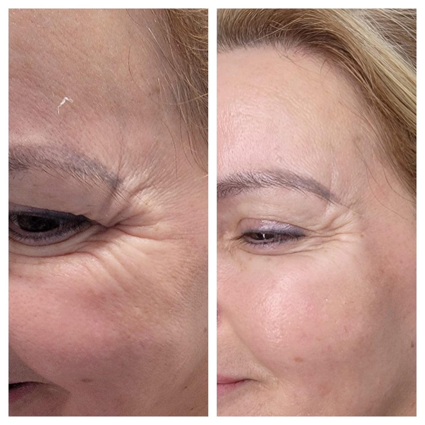 Cosmetic Botox. BEFORE AND AFTER