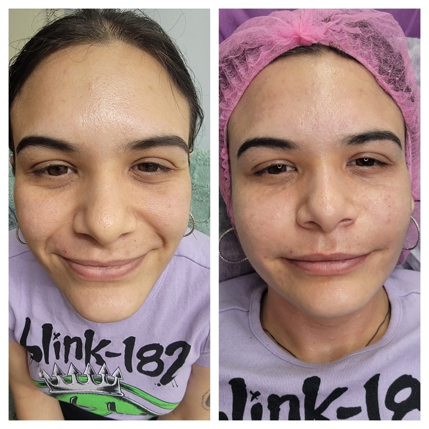 Platelet-rich plasma gel BEFORE AND AFTER