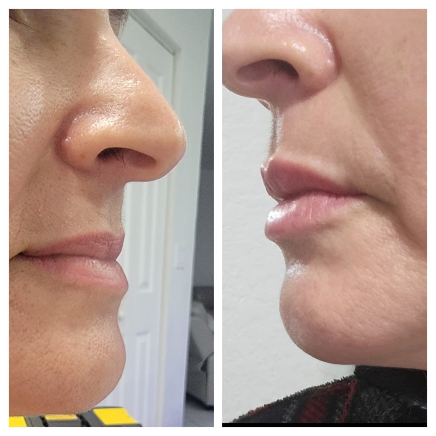 Lip fillers