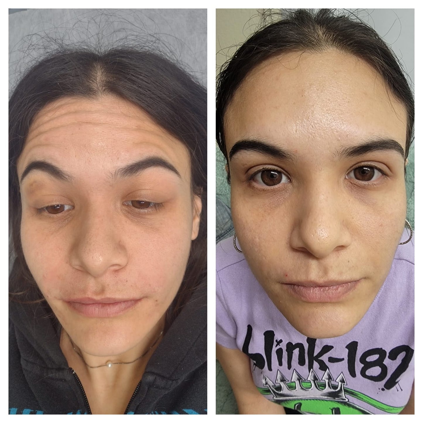 Cosmetic Botox. BEFORE AND AFTER