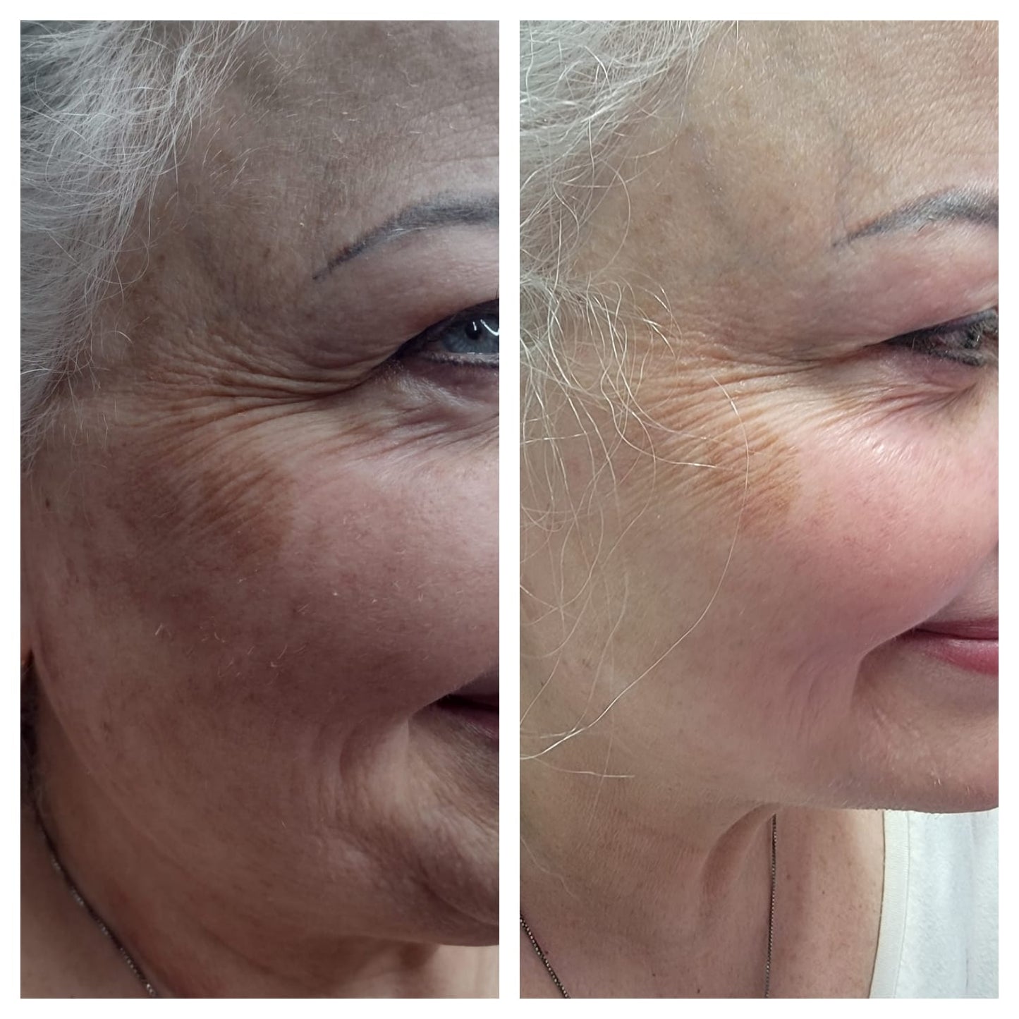 Cosmetic Botox. BEFORE AND AFTER
