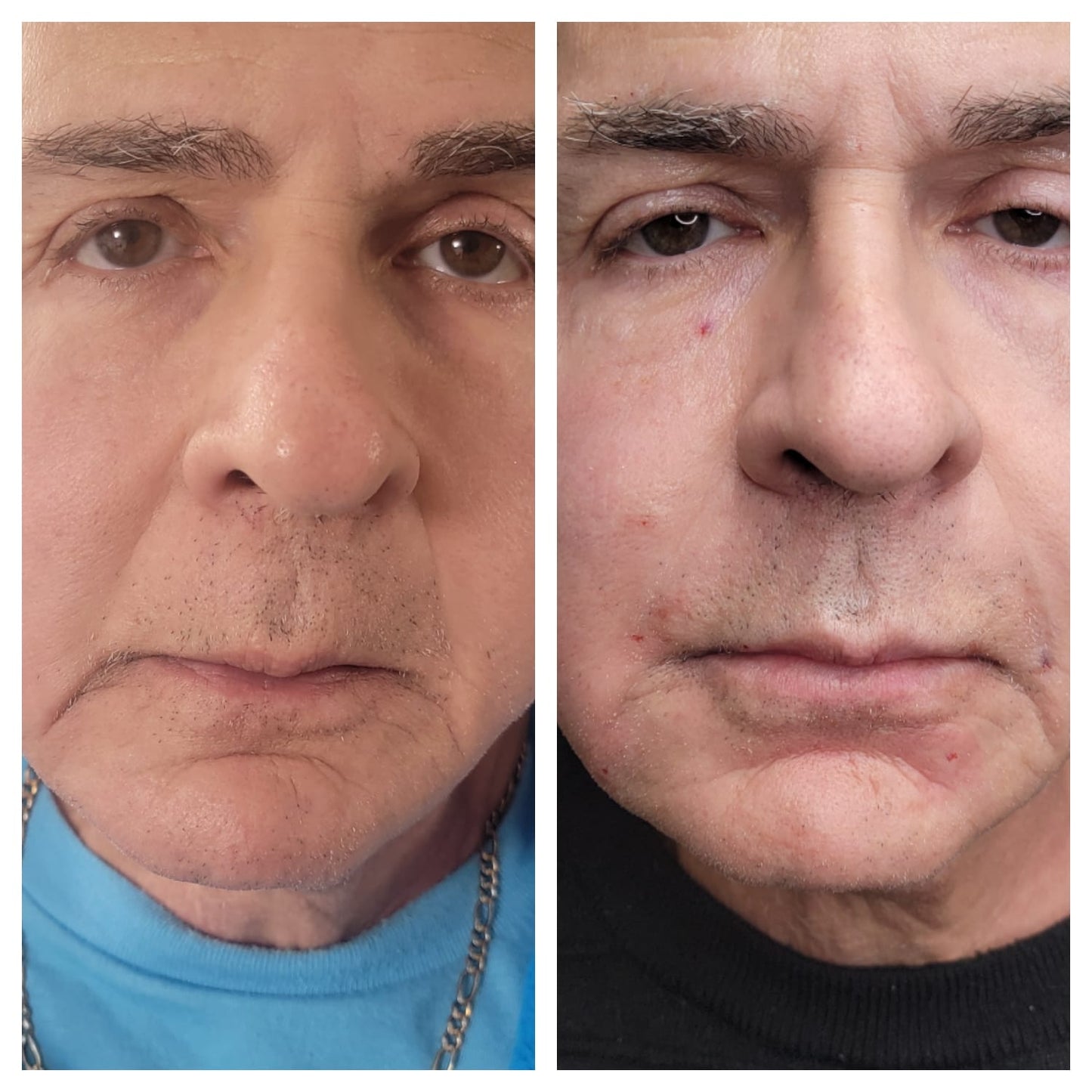 Platelet-rich plasma gel BEFORE AND AFTER