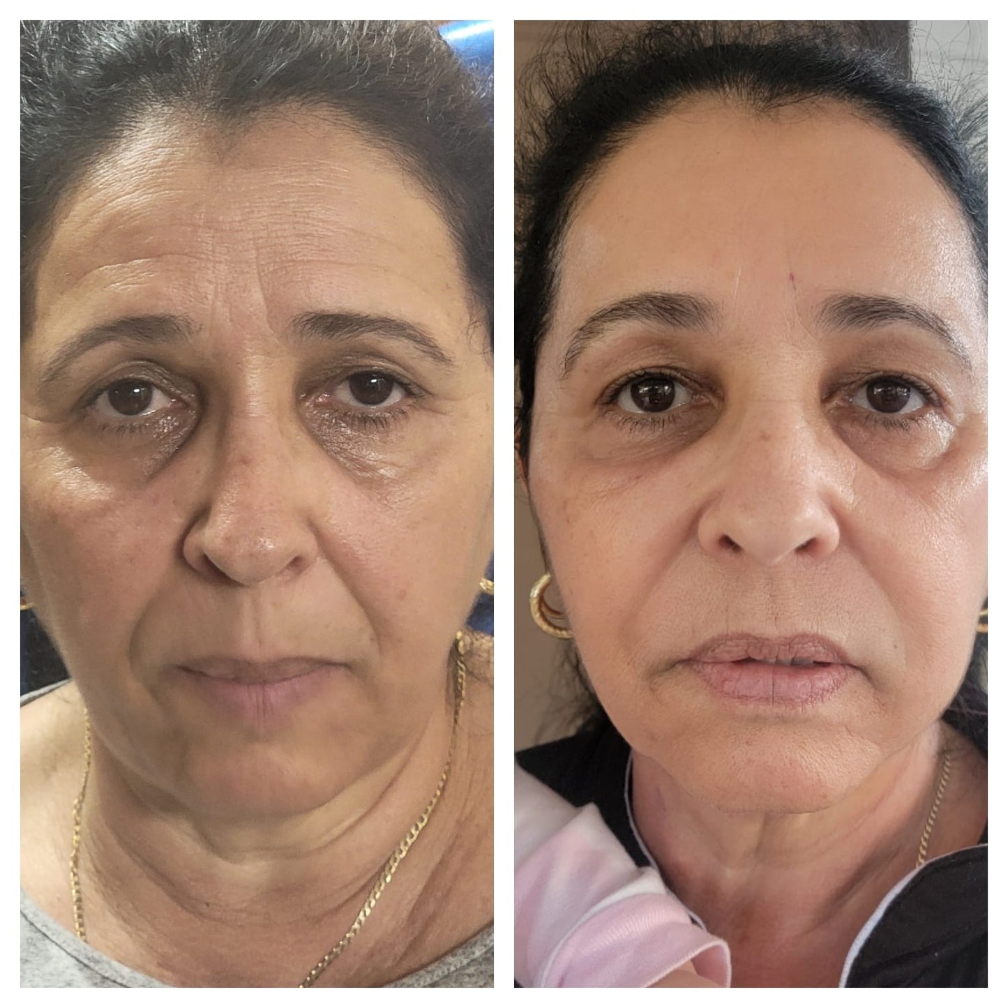 Platelet-rich plasma gel BEFORE AND AFTER