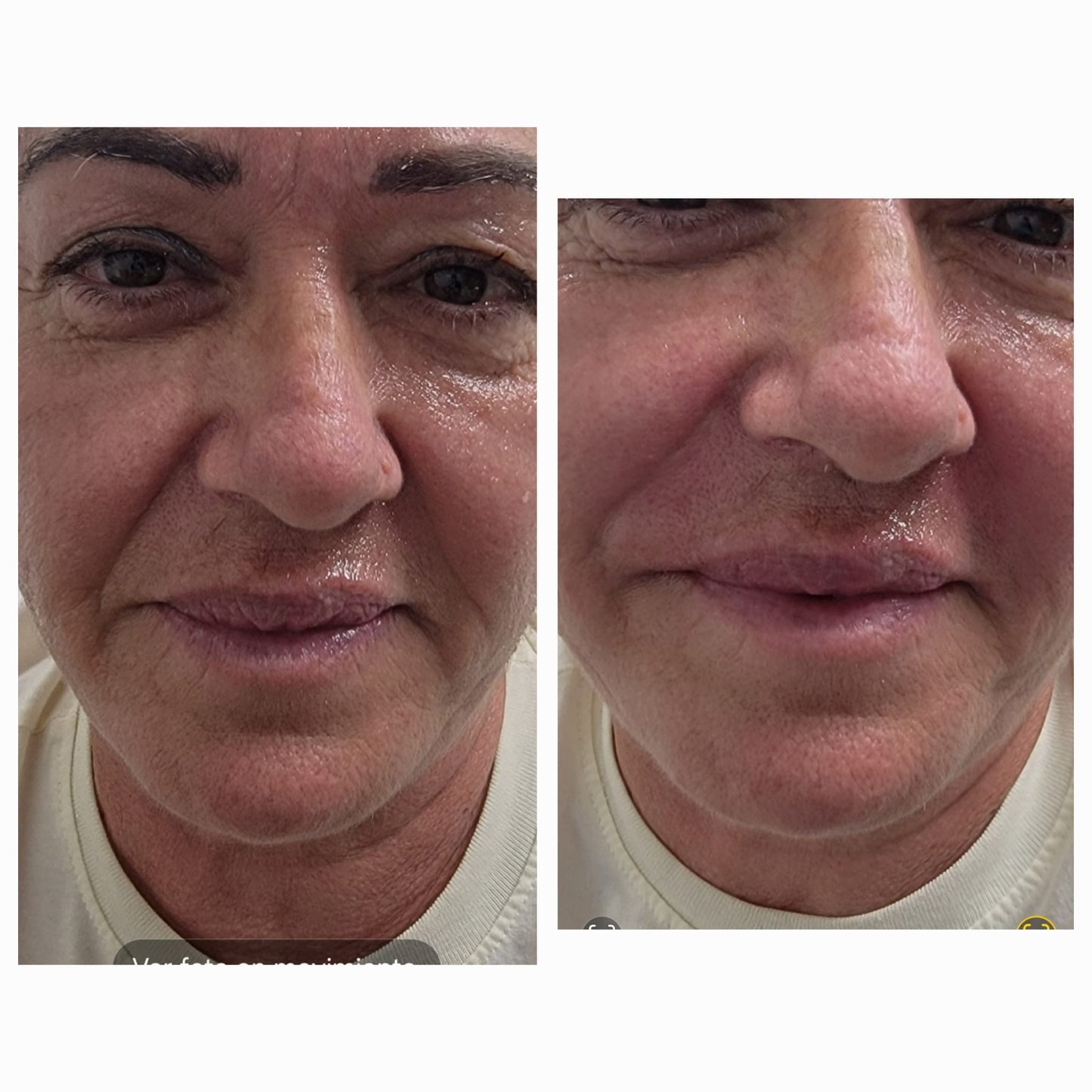 Platelet-rich plasma gel BEFORE AND AFTER