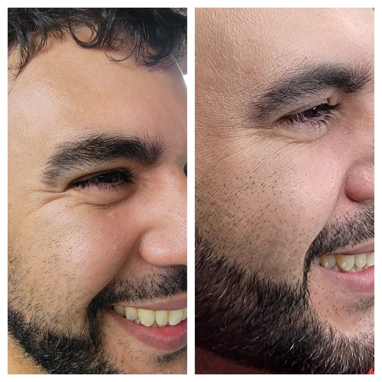 Cosmetic Botox. BEFORE AND AFTER