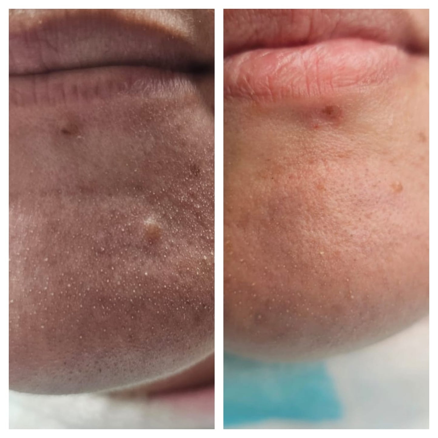Electrocautery BEFORE AND AFTER