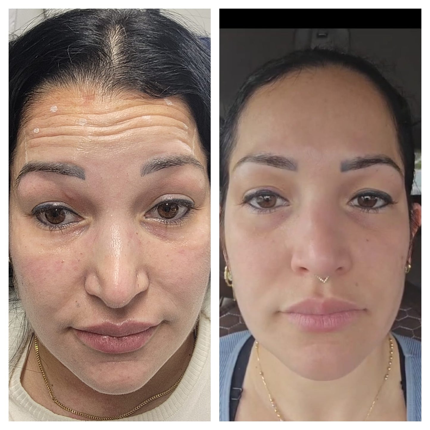 Cosmetic Botox. BEFORE AND AFTER