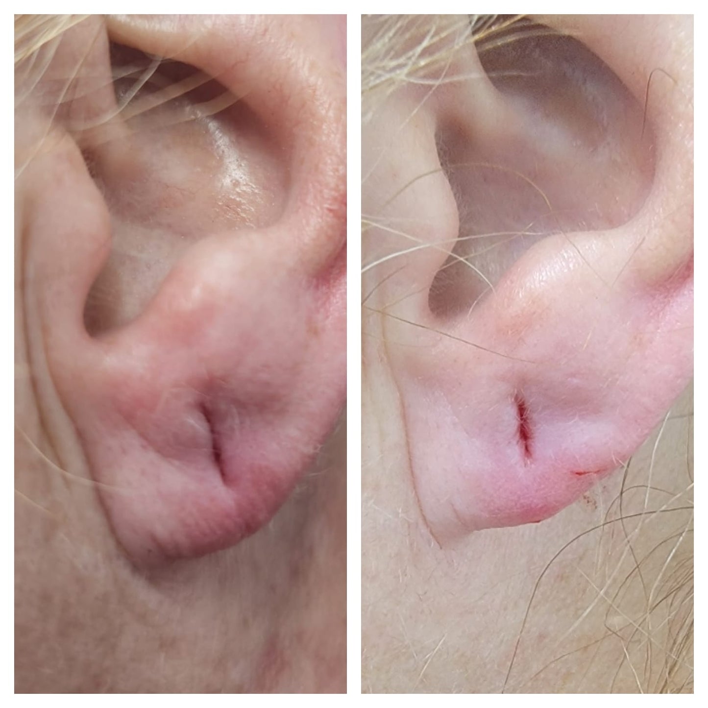 Earlobe Fillers
