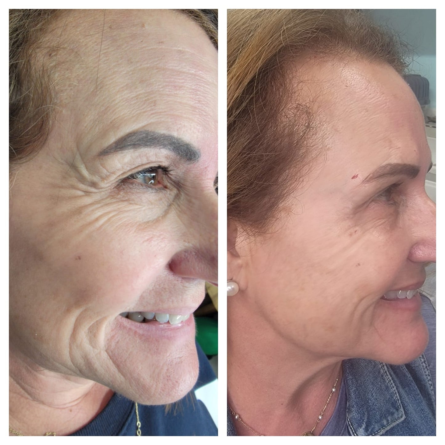 Cosmetic Botox. BEFORE AND AFTER