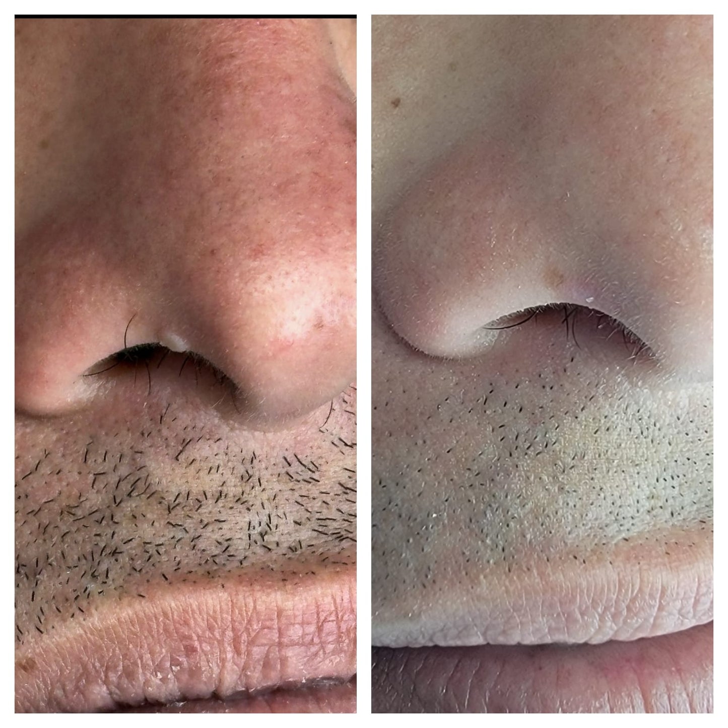 Electrocautery BEFORE AND AFTER