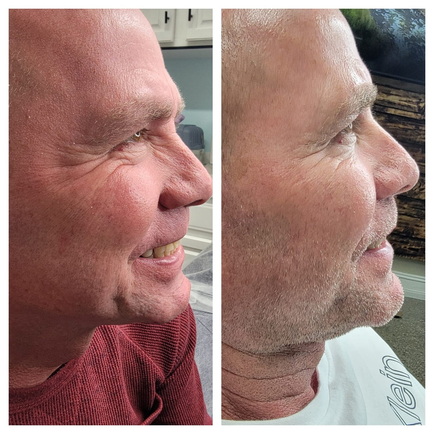 Cosmetic Botox. BEFORE AND AFTER