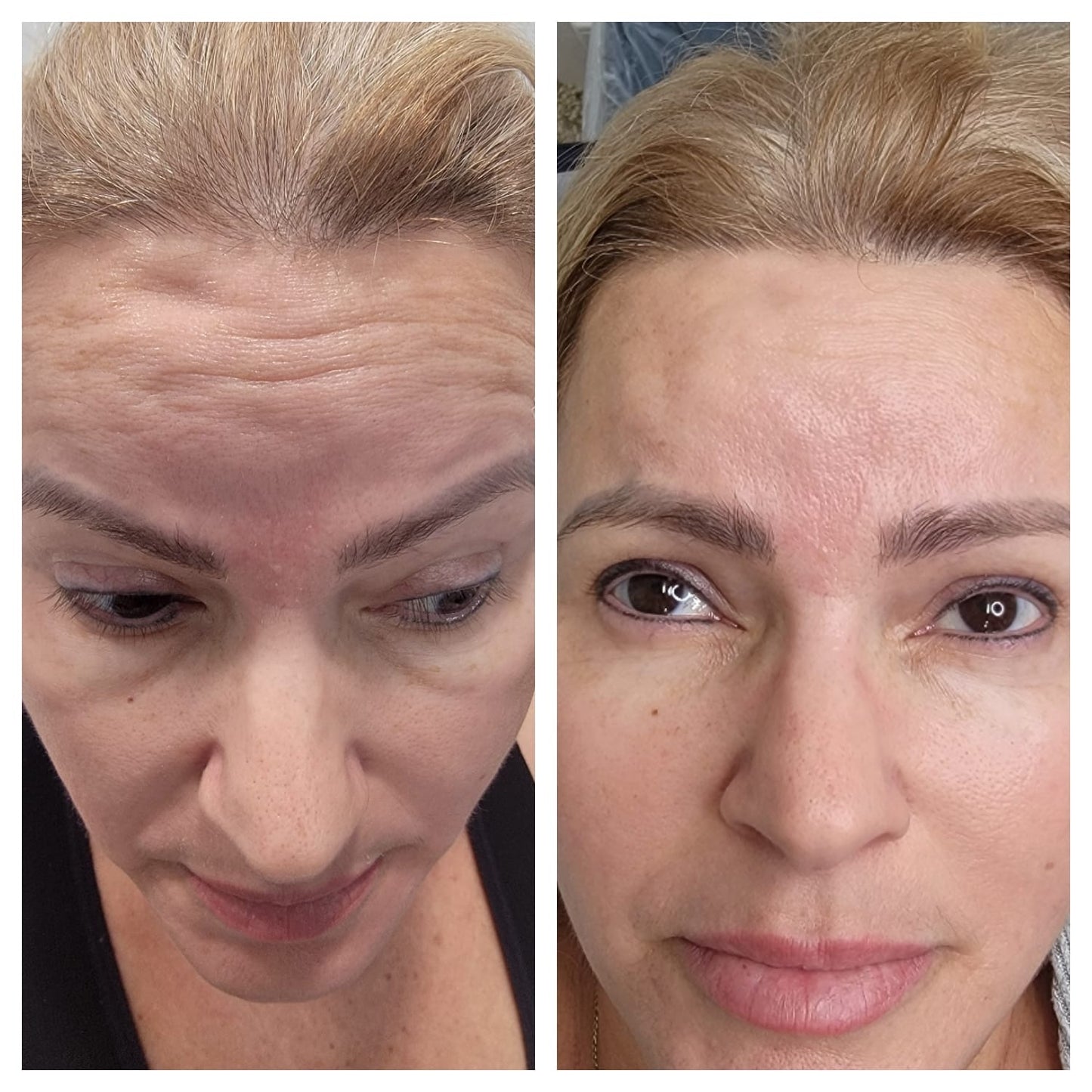 Cosmetic Botox.   BEFORE AND AFTER