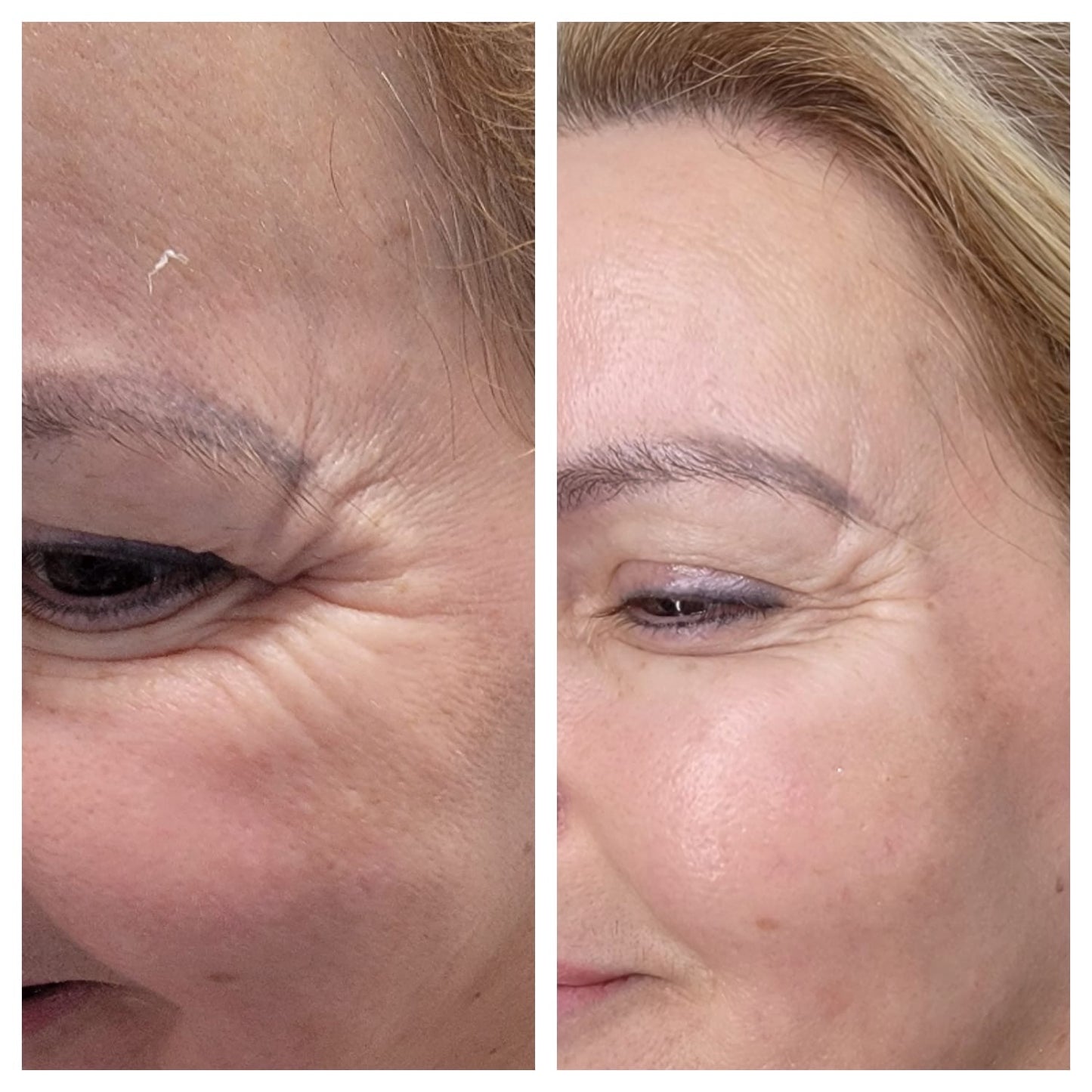 Cosmetic Botox.   BEFORE AND AFTER