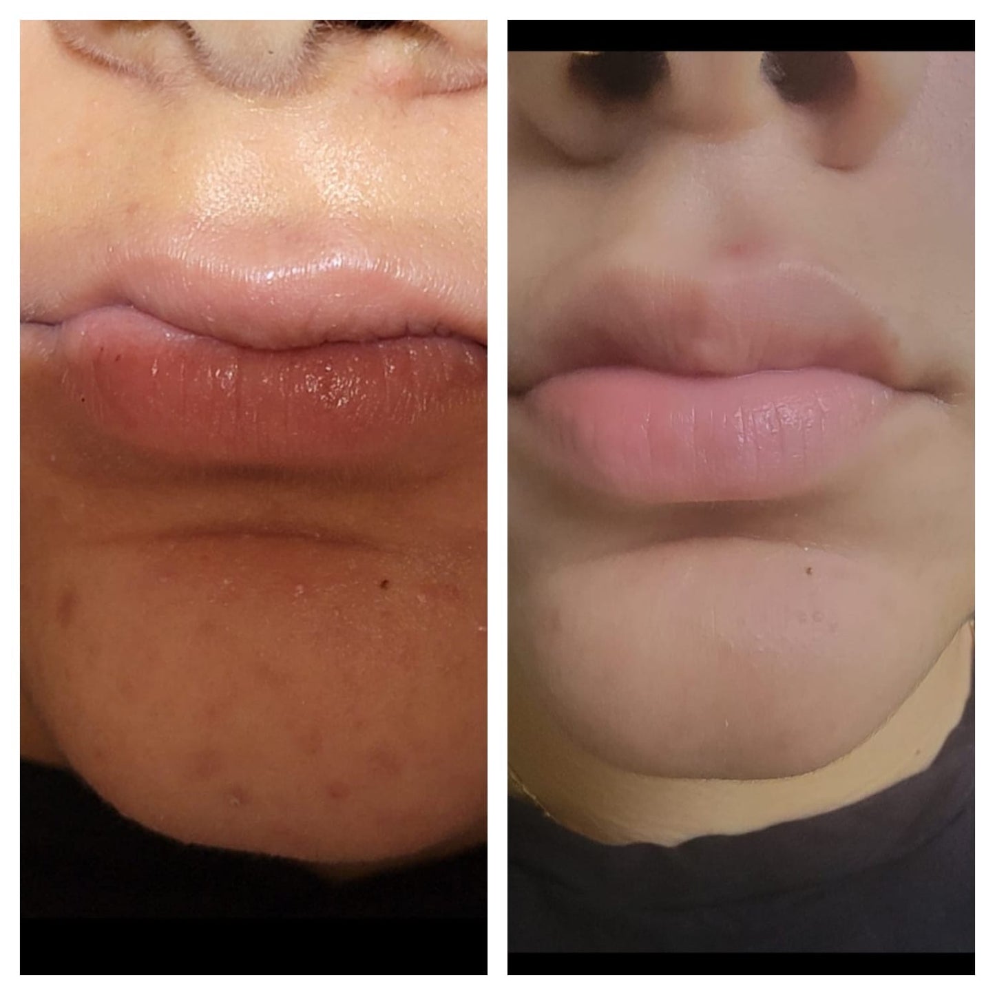 Lip fillers. BEFORE AND AFTER