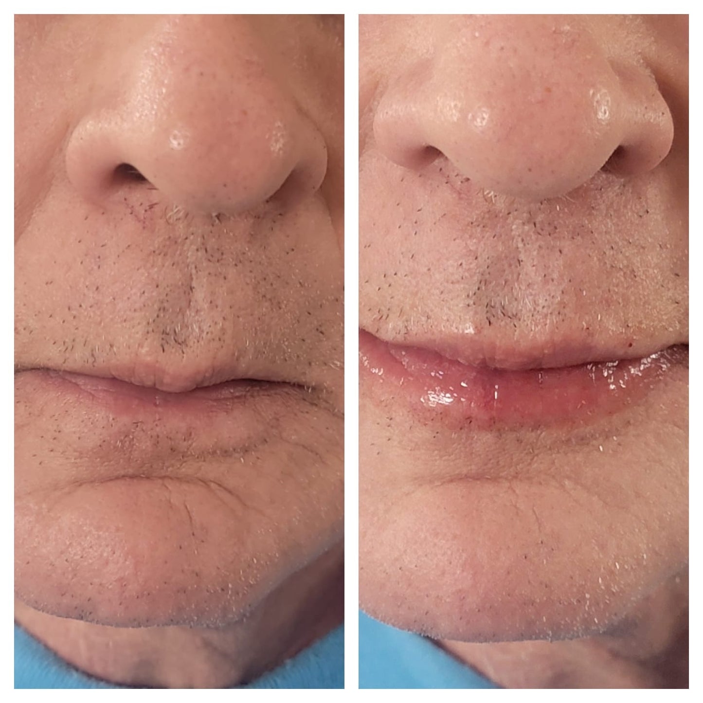 Lip fillers. BEFORE AND AFTER