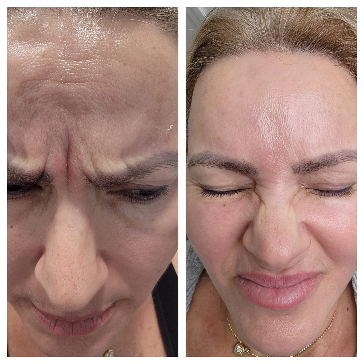 Cosmetic Botox.   BEFORE AND AFTER