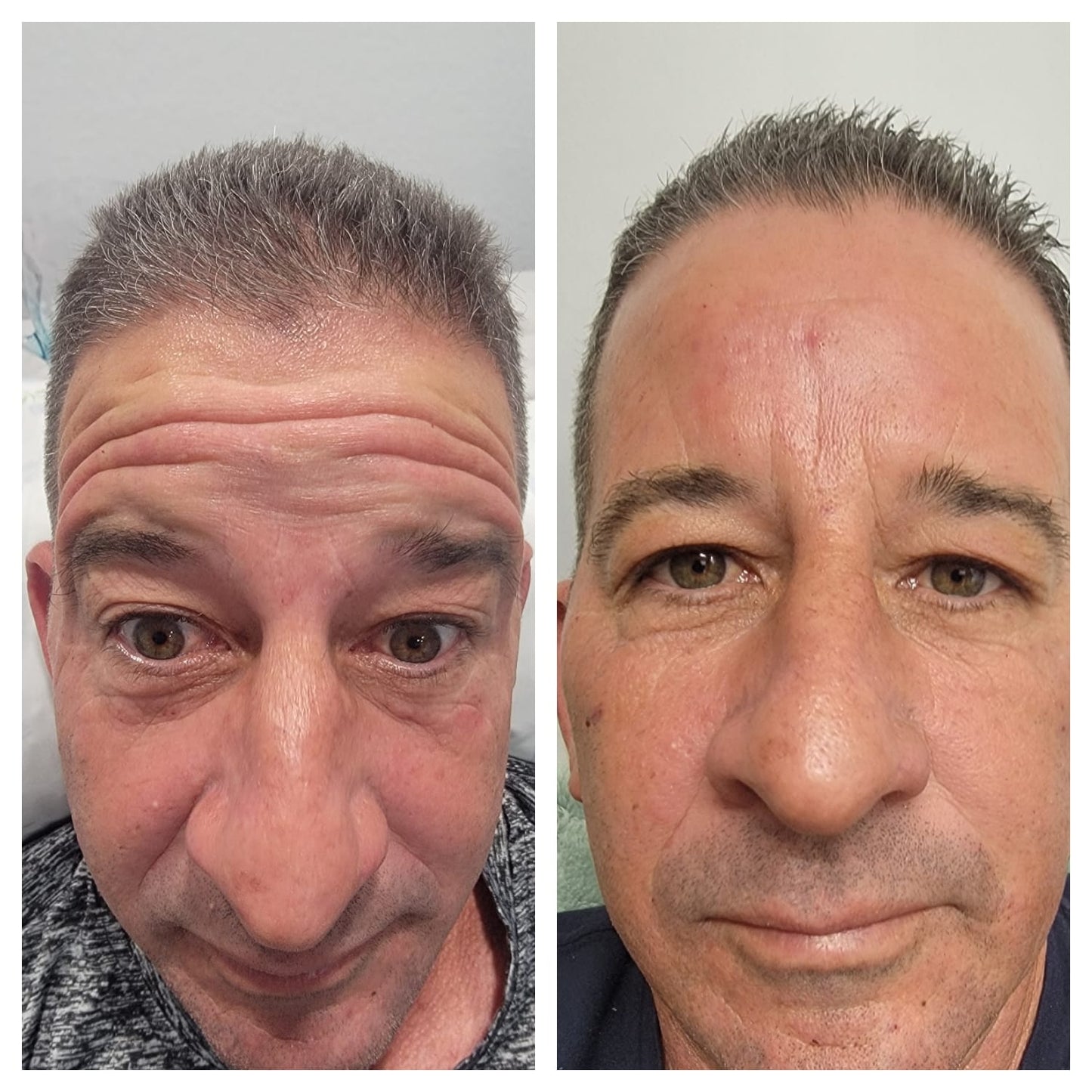 Cosmetic Botox.   BEFORE AND AFTER