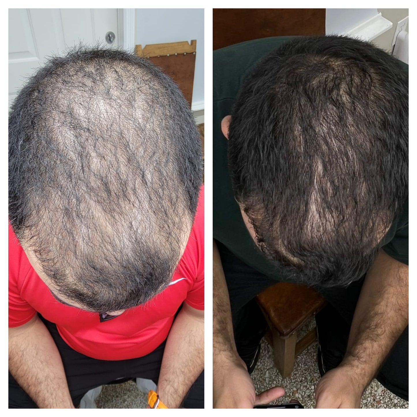 Platelet-rich plasma  BEFORE AND AFTER