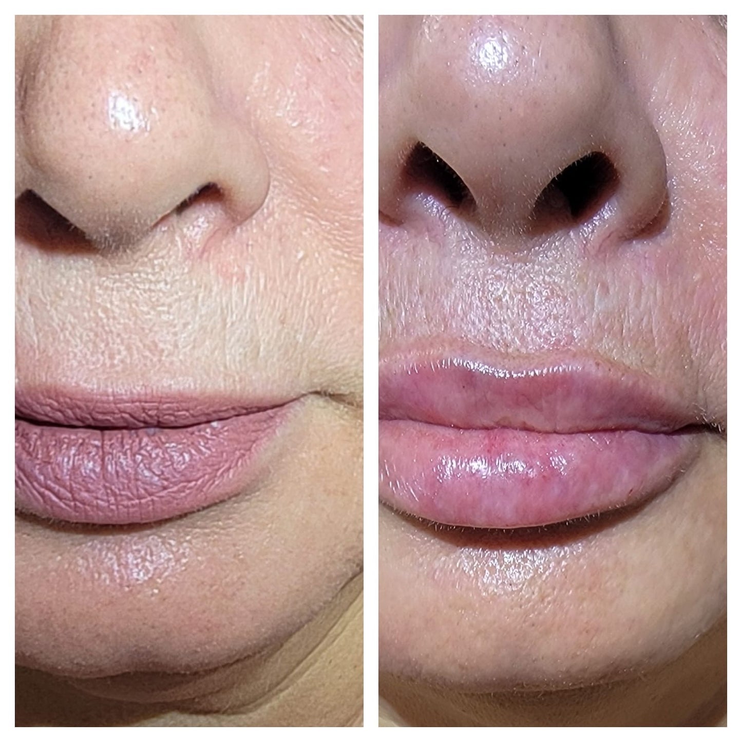 Lip fillers. BEFORE AND AFTER