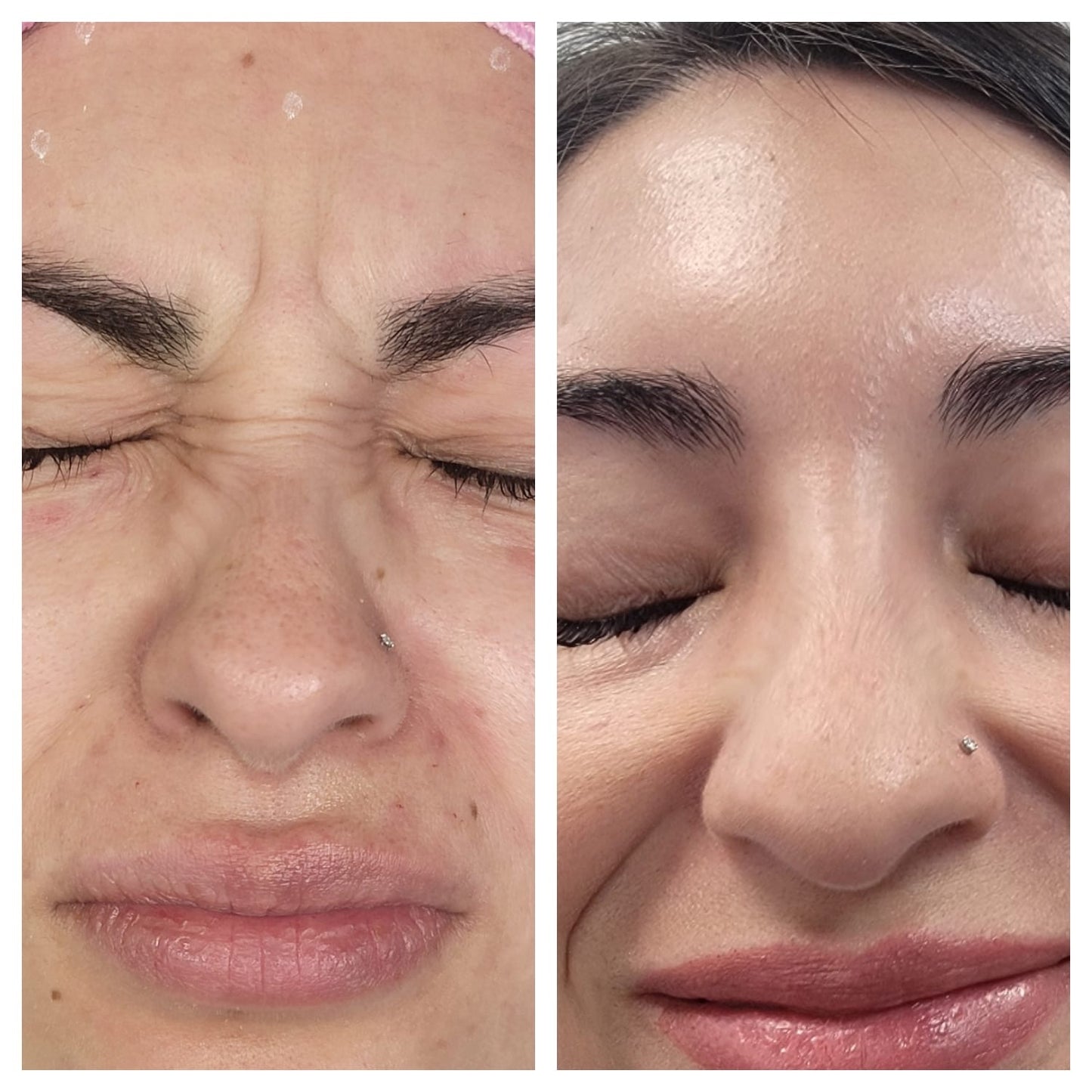 Cosmetic Botox.   BEFORE AND AFTER