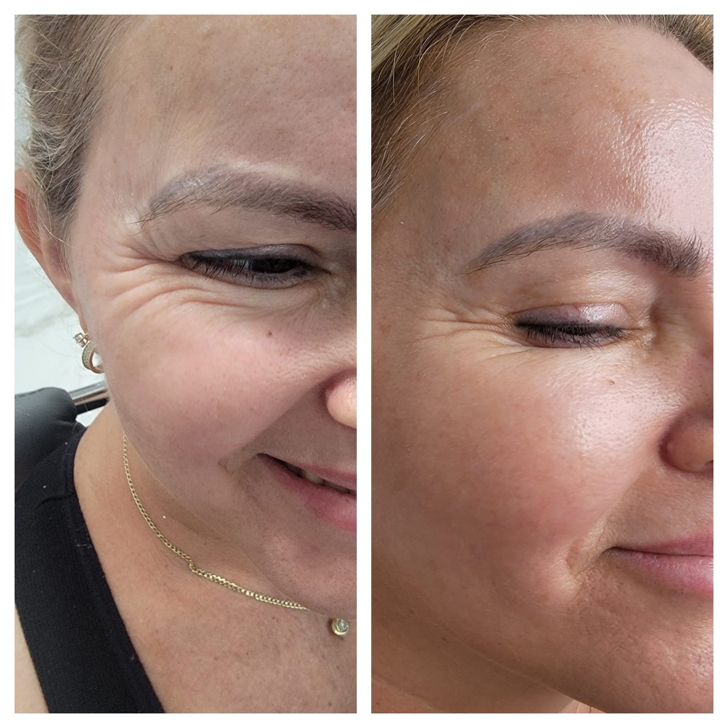 Cosmetic Botox.   BEFORE AND AFTER