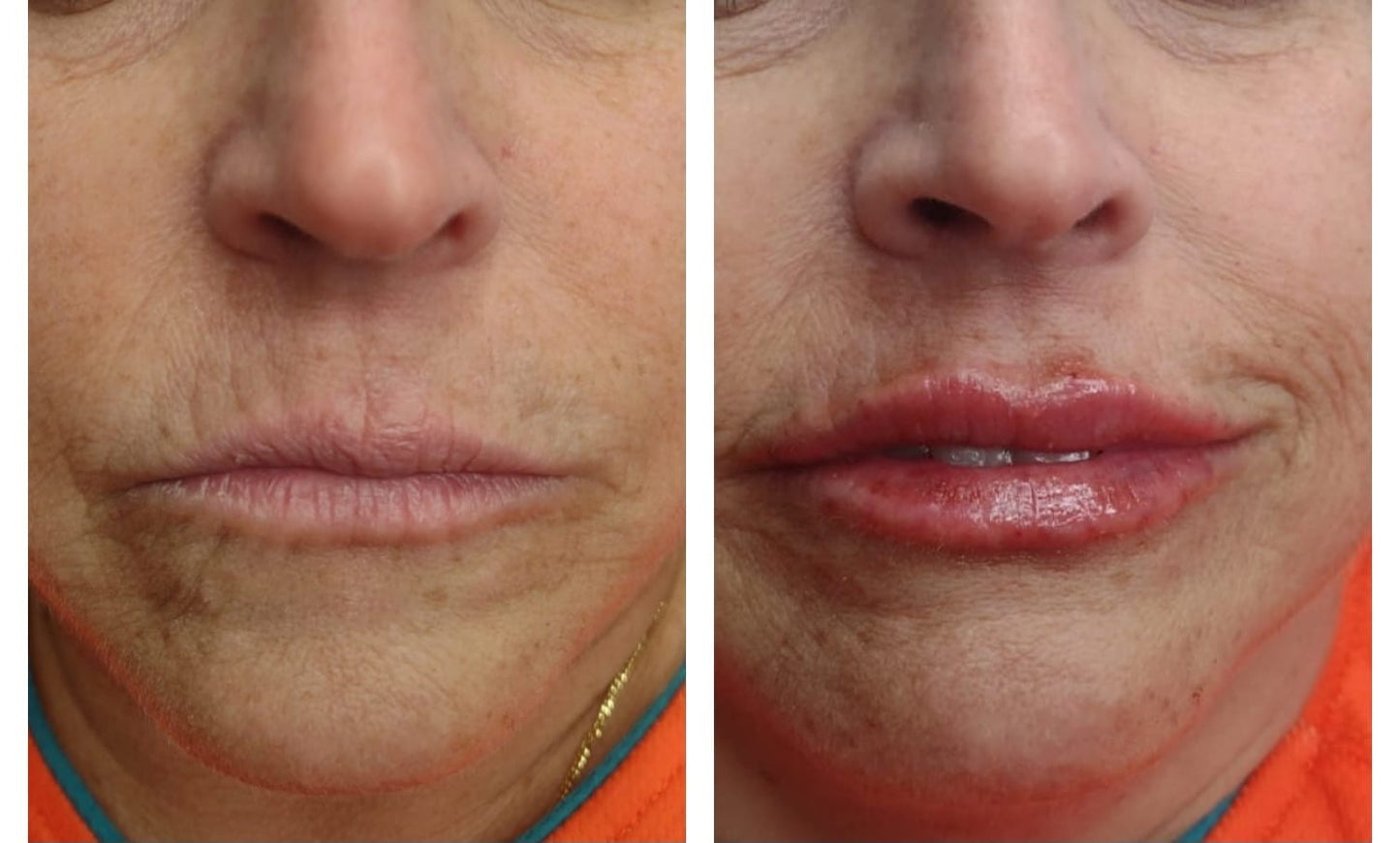 Lip fillers. BEFORE AND AFTER