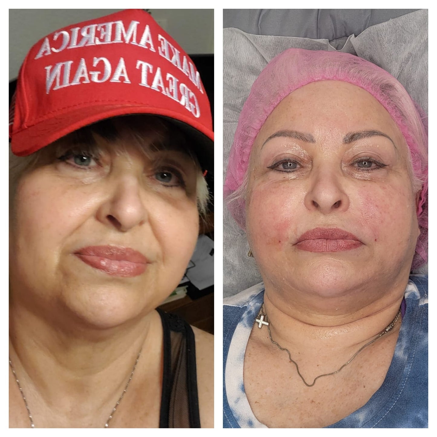 Platelet-rich plasma gel  BEFORE AND AFTER