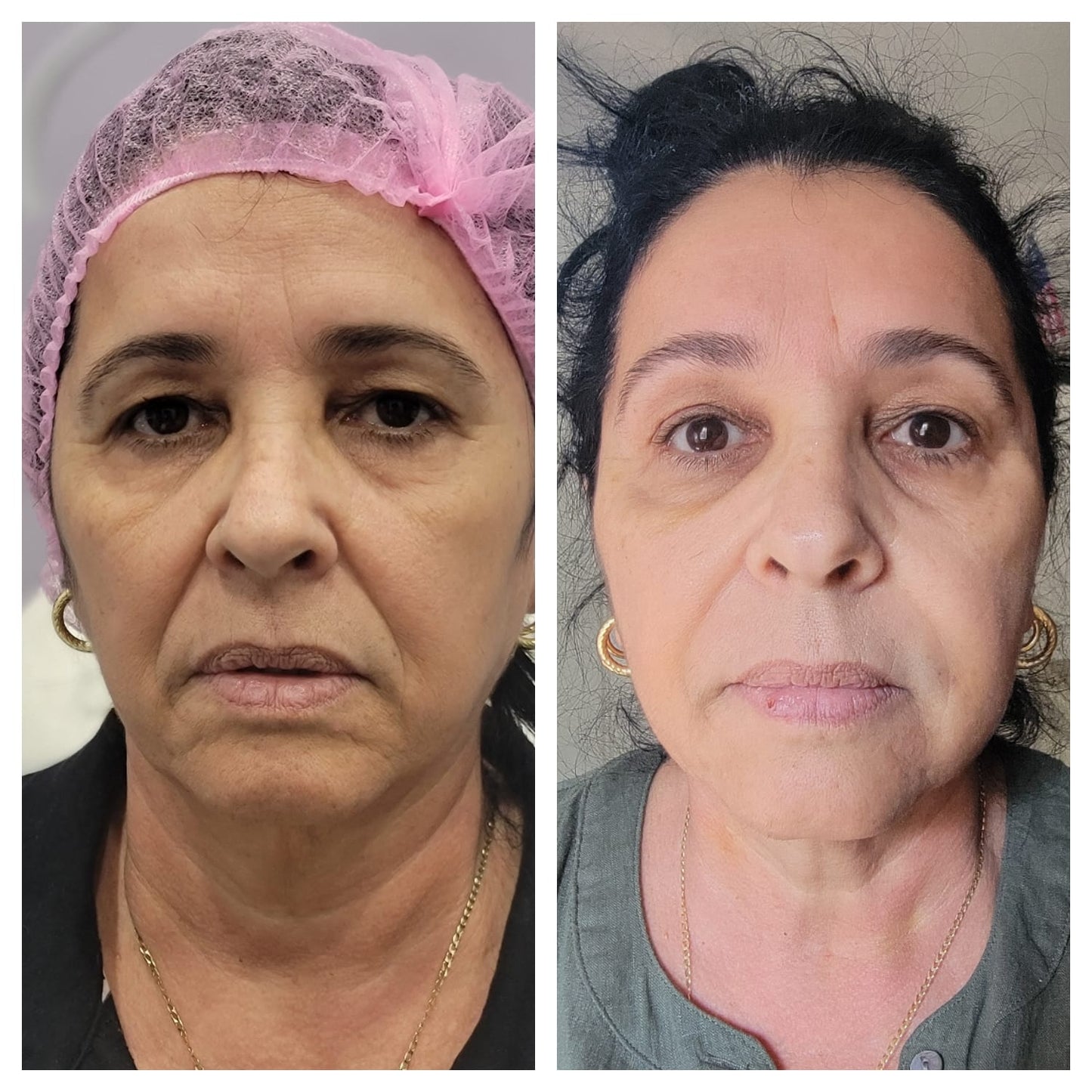 Platelet-rich plasma  BEFORE AND AFTER