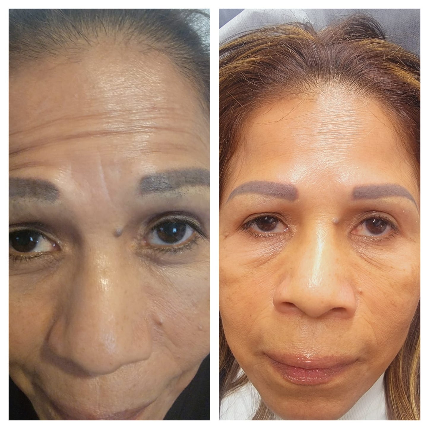 Cosmetic Botox.   BEFORE AND AFTER