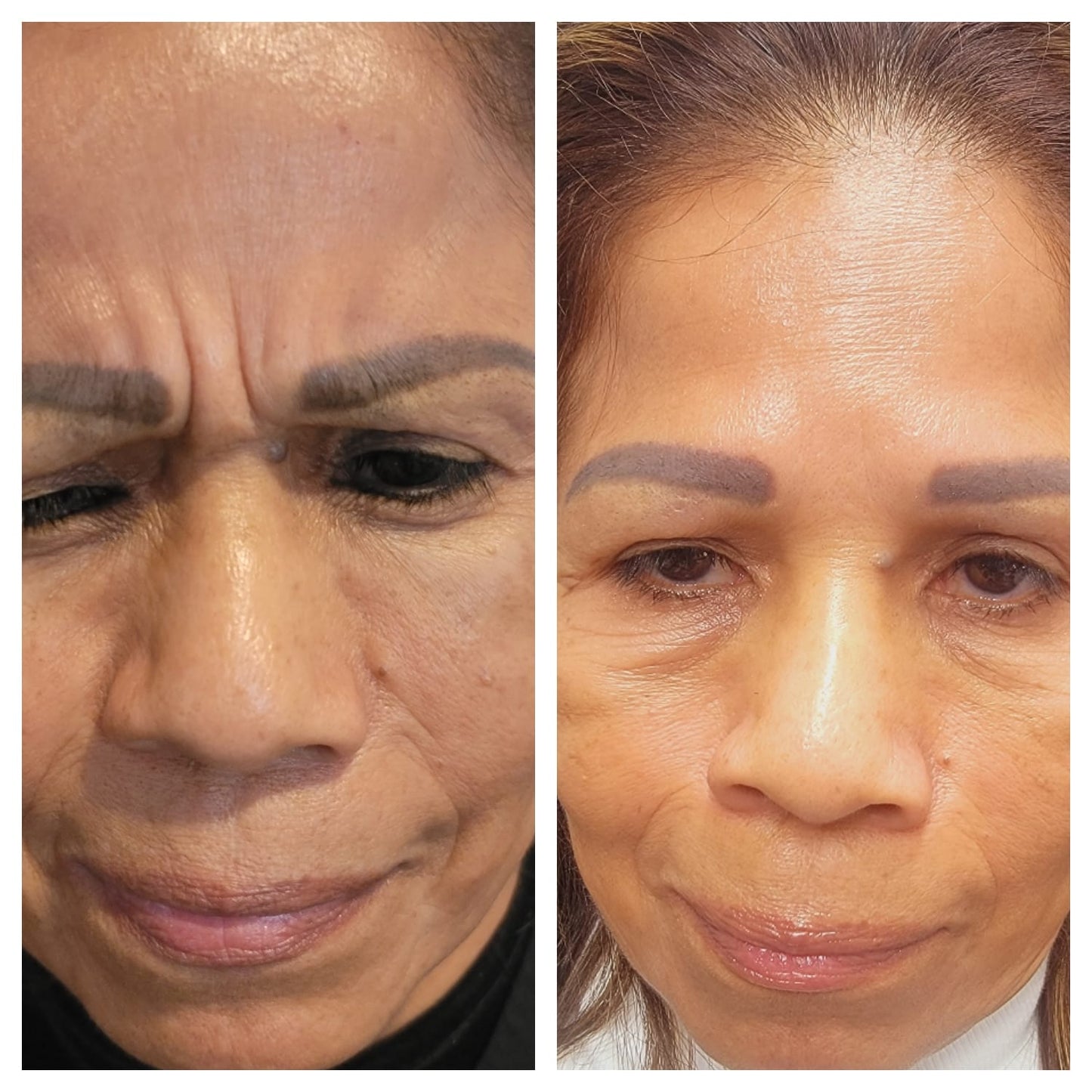 Cosmetic Botox.   BEFORE AND AFTER