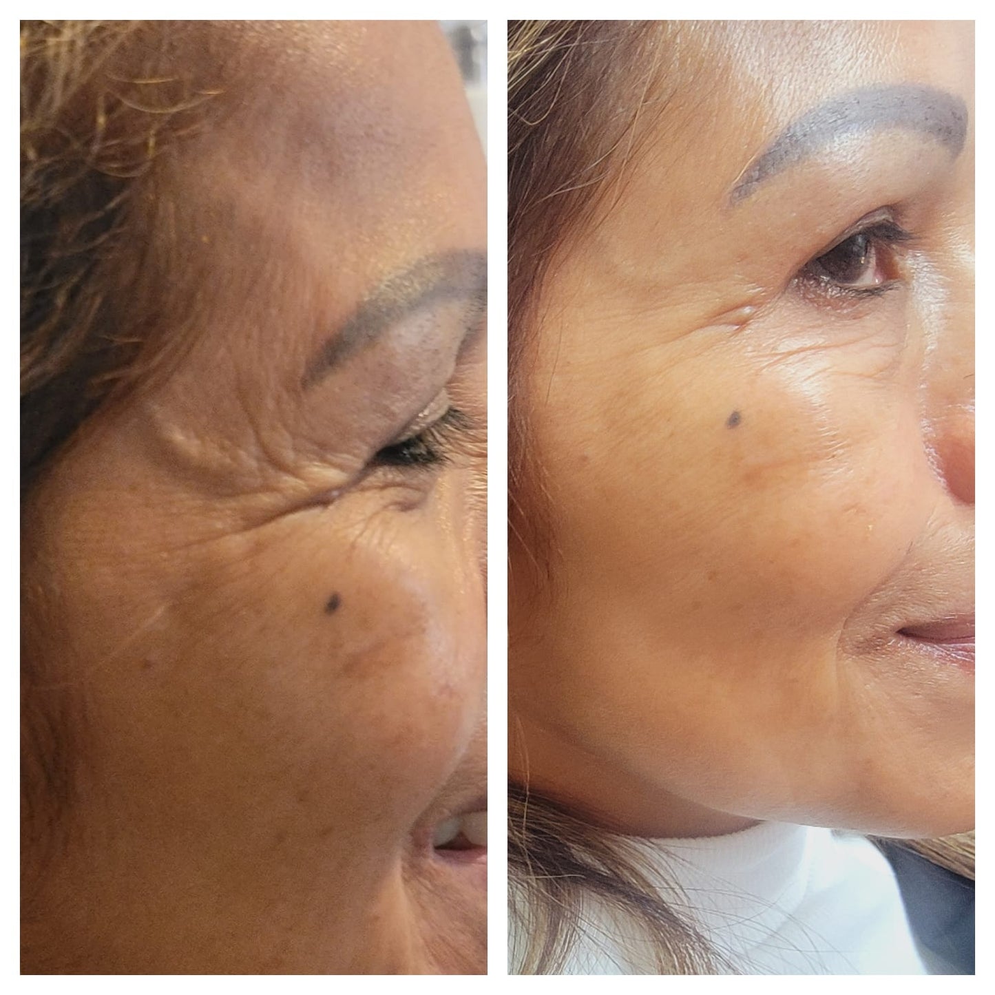 Cosmetic Botox.   BEFORE AND AFTER