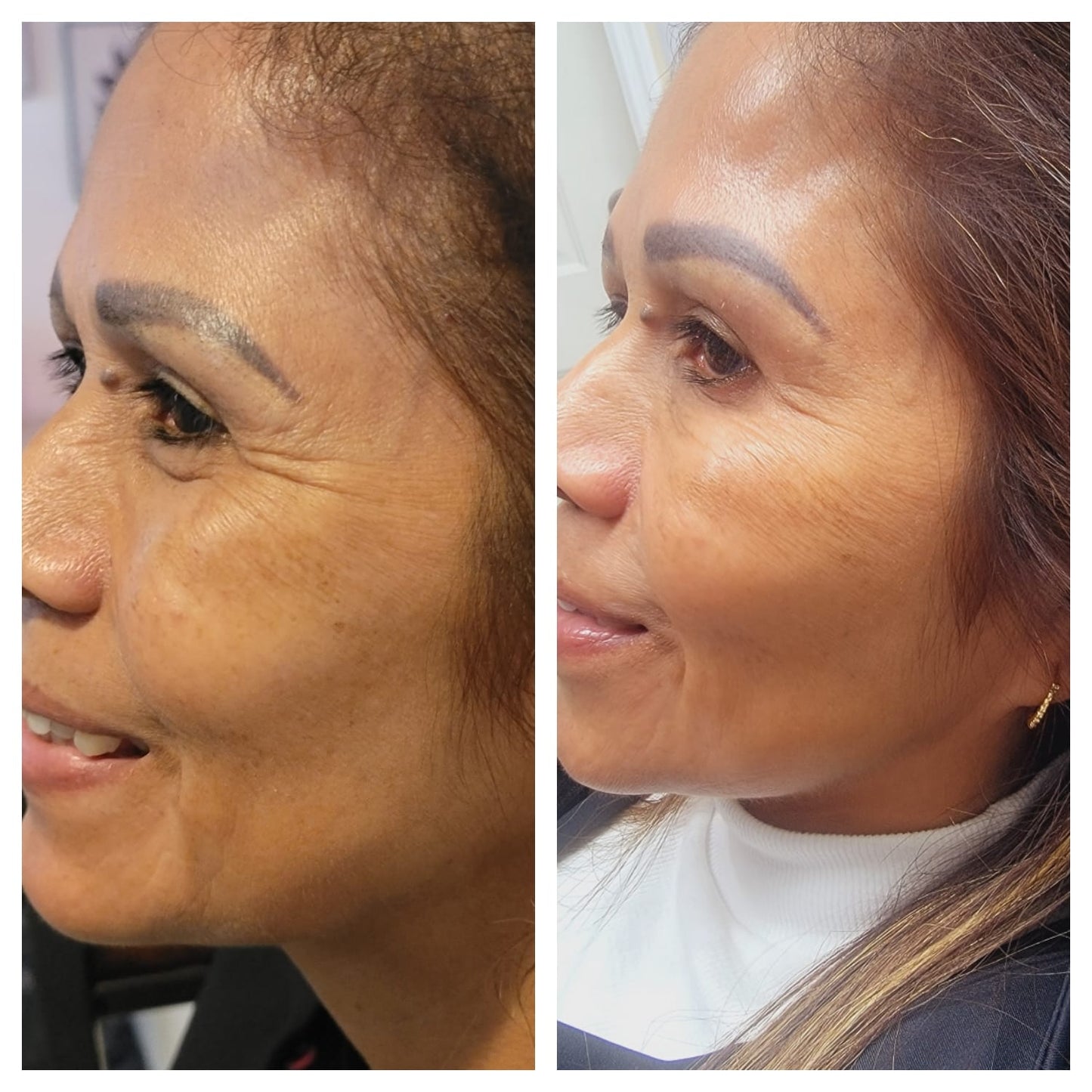 Cosmetic Botox.   BEFORE AND AFTER