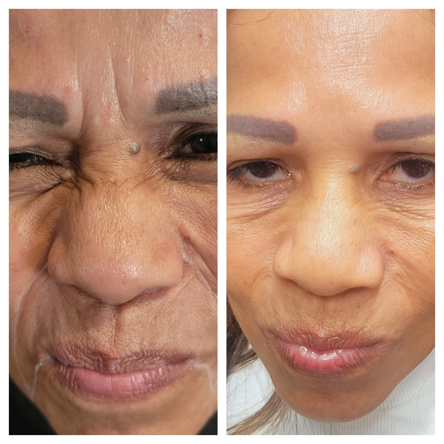 Cosmetic Botox.   BEFORE AND AFTER