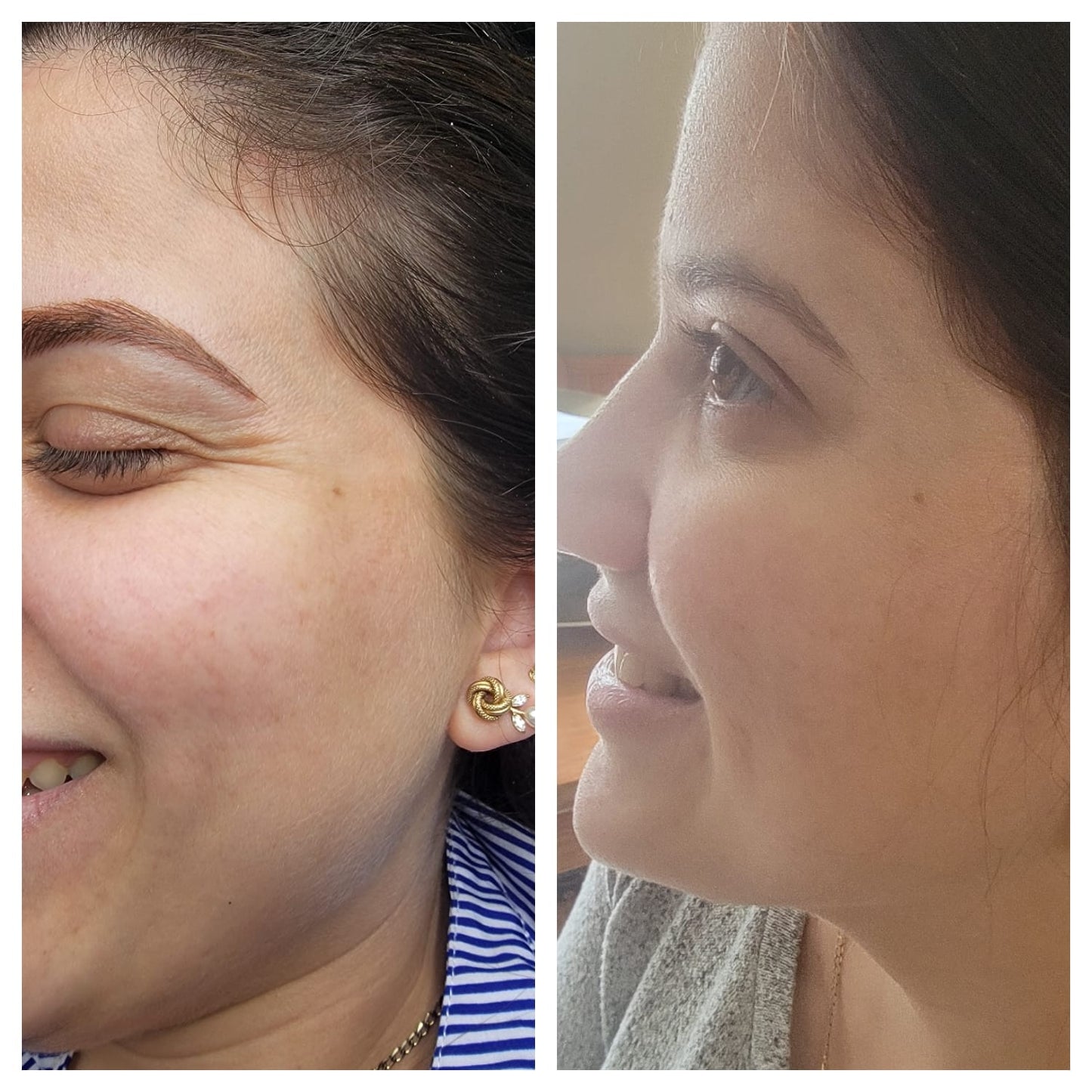 Cosmetic Botox.   BEFORE AND AFTER