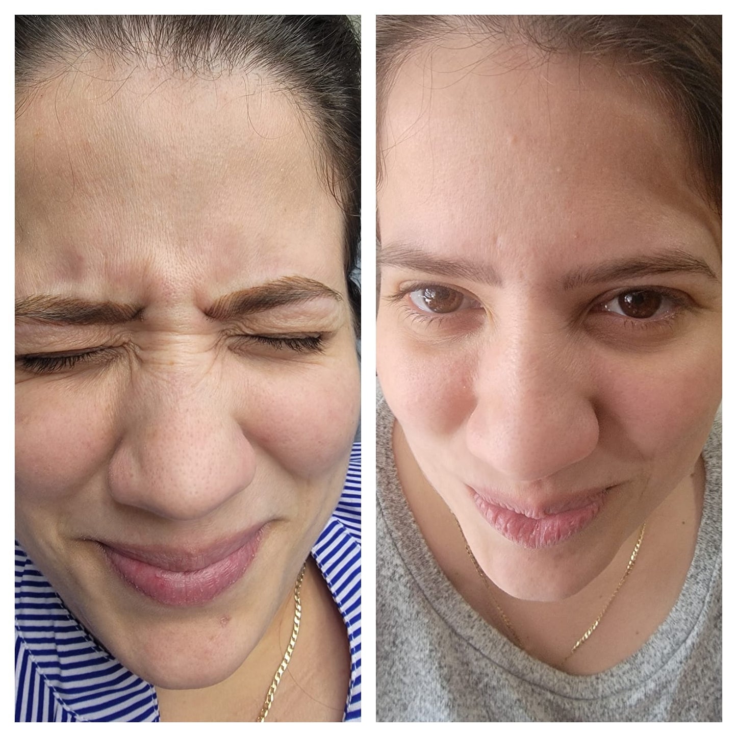 Cosmetic Botox.   BEFORE AND AFTER