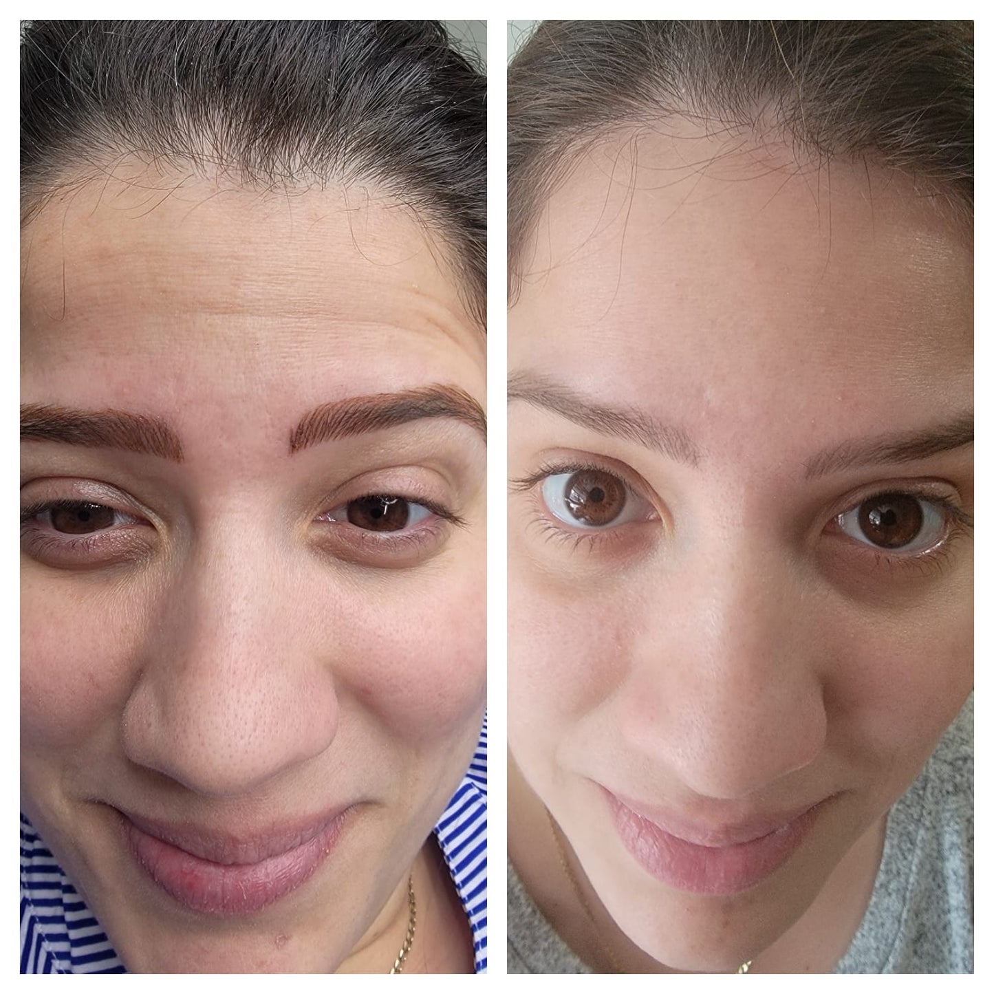 Cosmetic Botox.   BEFORE AND AFTER