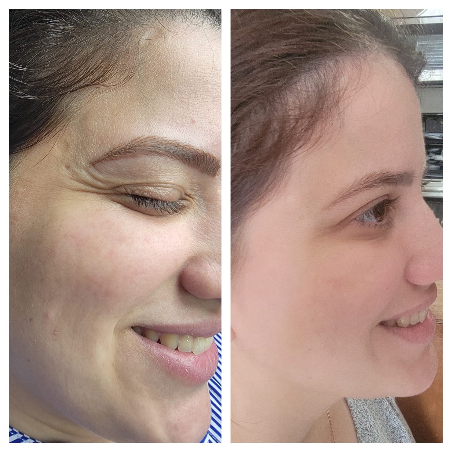 Cosmetic Botox.   BEFORE AND AFTER