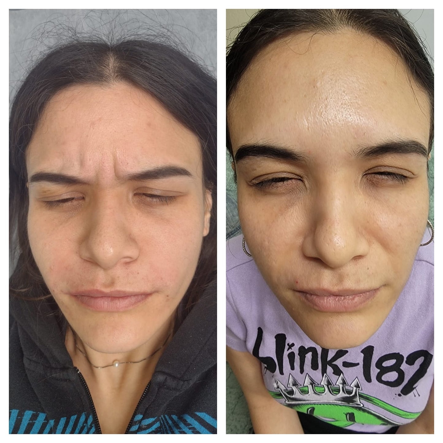 Cosmetic Botox.   BEFORE AND AFTER