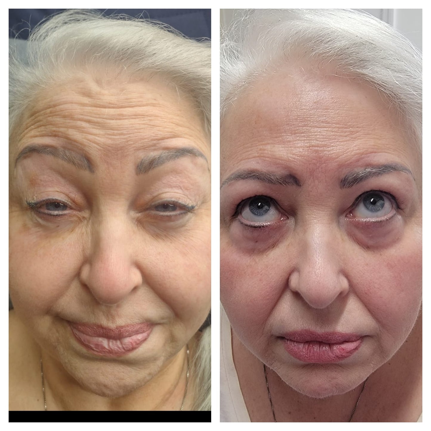 Cosmetic Botox.   BEFORE AND AFTER