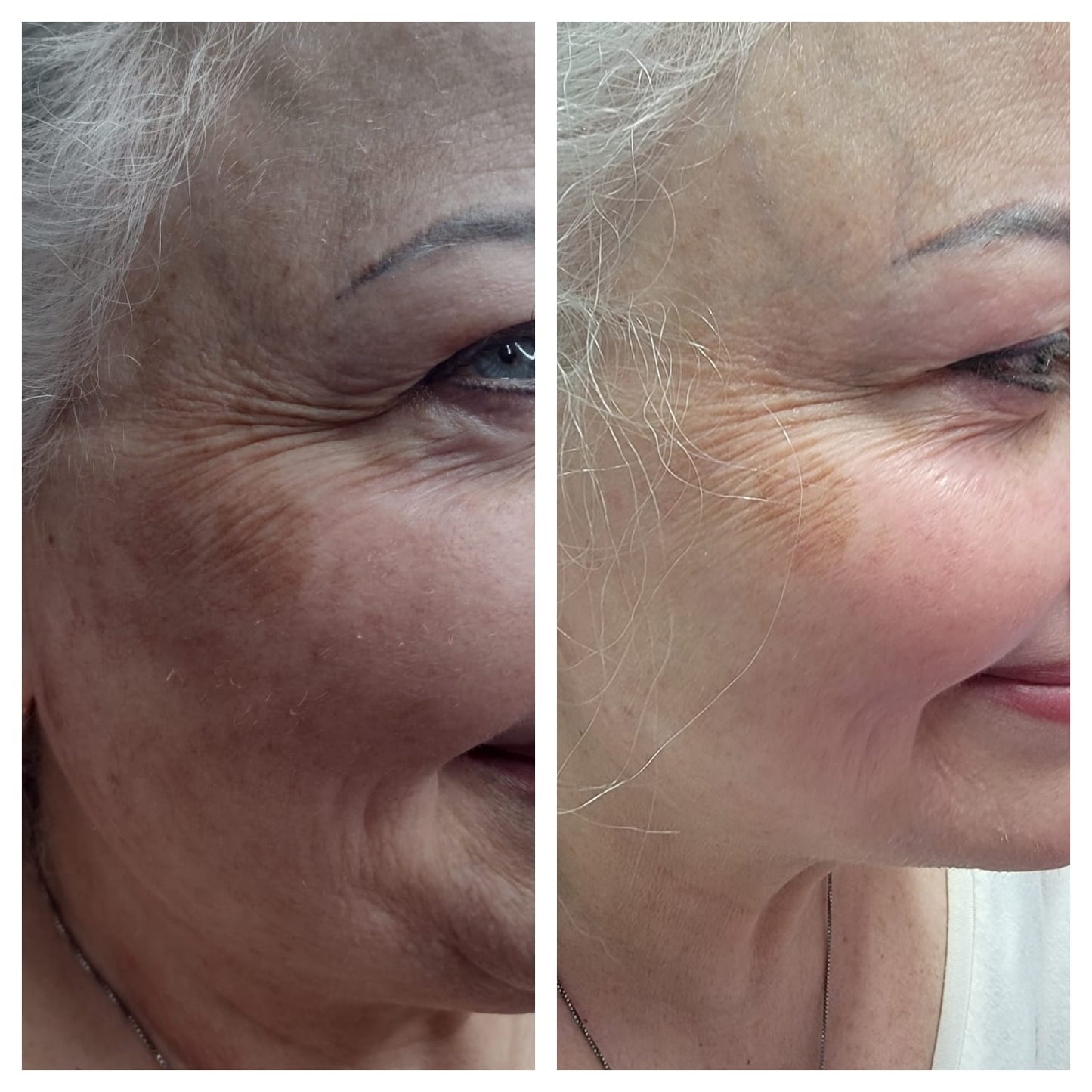 Cosmetic Botox.   BEFORE AND AFTER