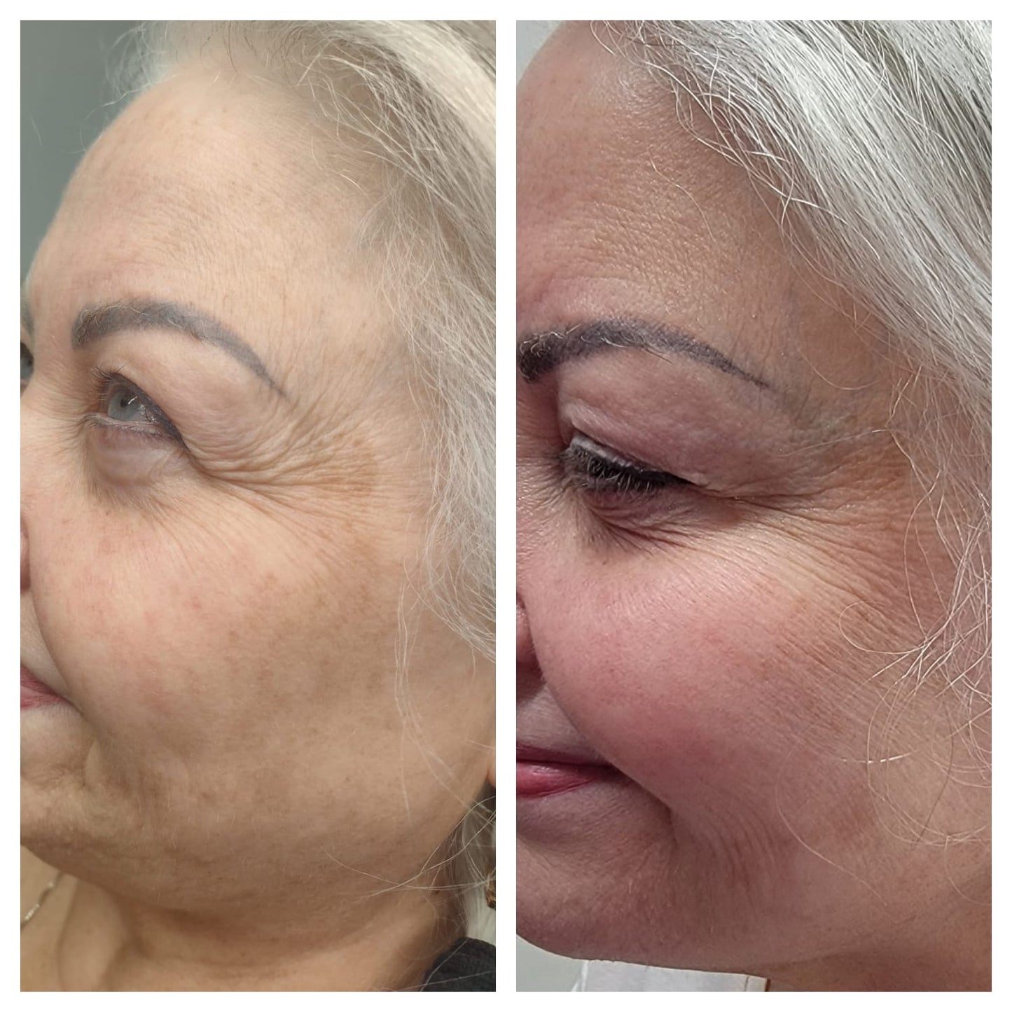 Cosmetic Botox.   BEFORE AND AFTER