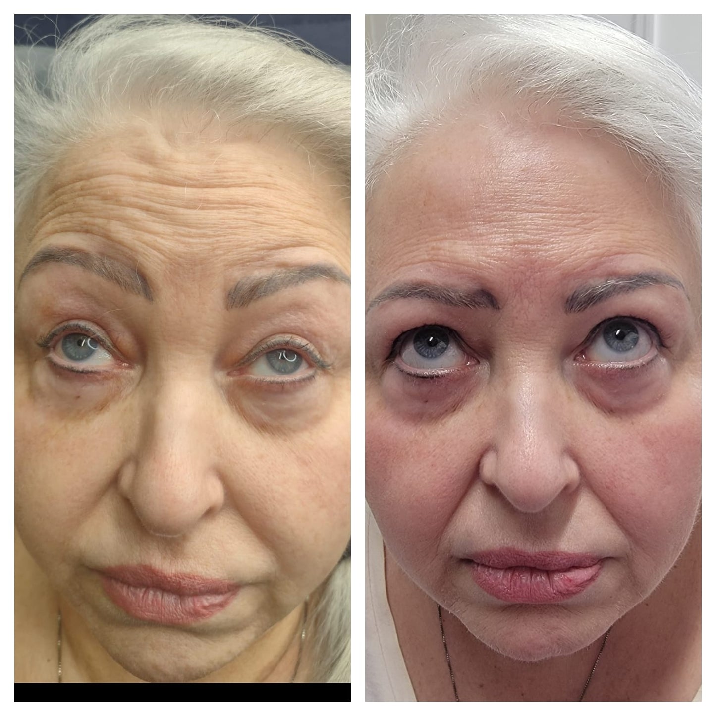 Cosmetic Botox.   BEFORE AND AFTER