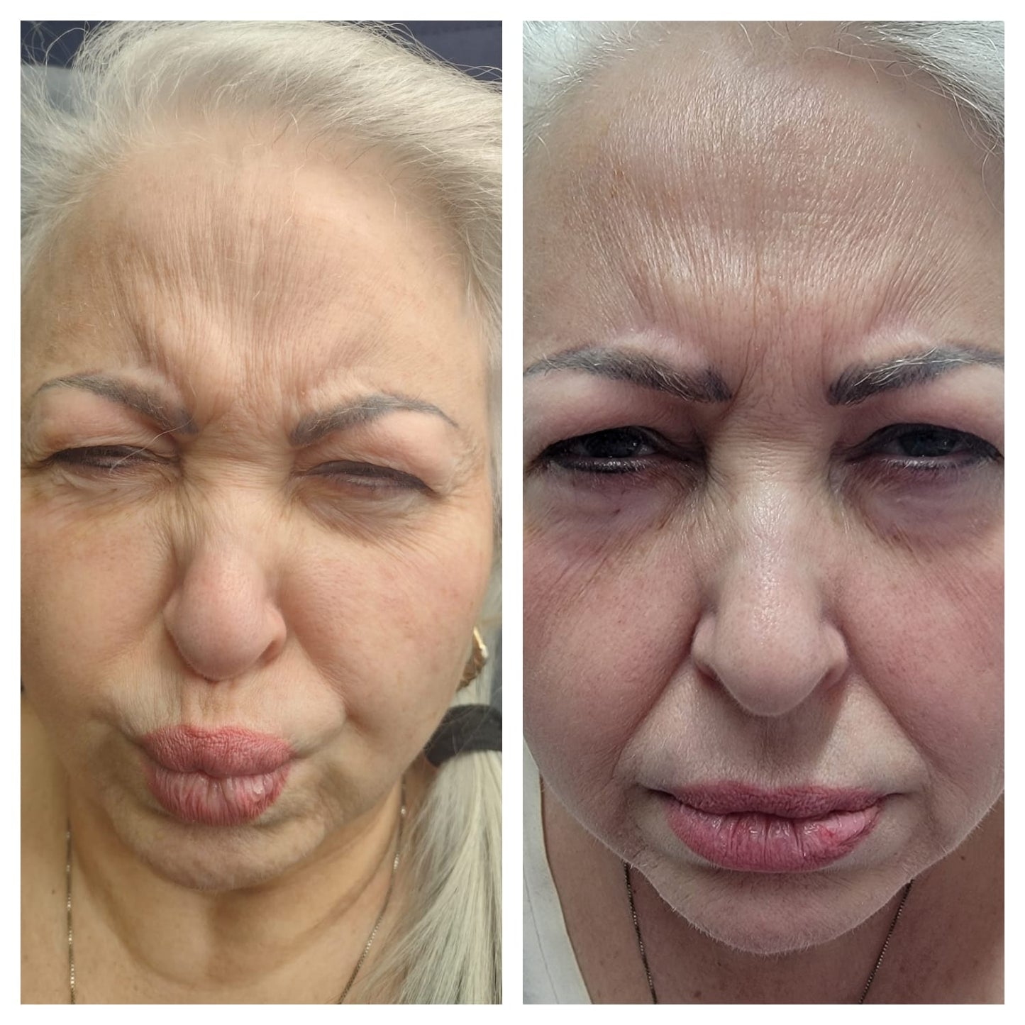 Cosmetic Botox.   BEFORE AND AFTER