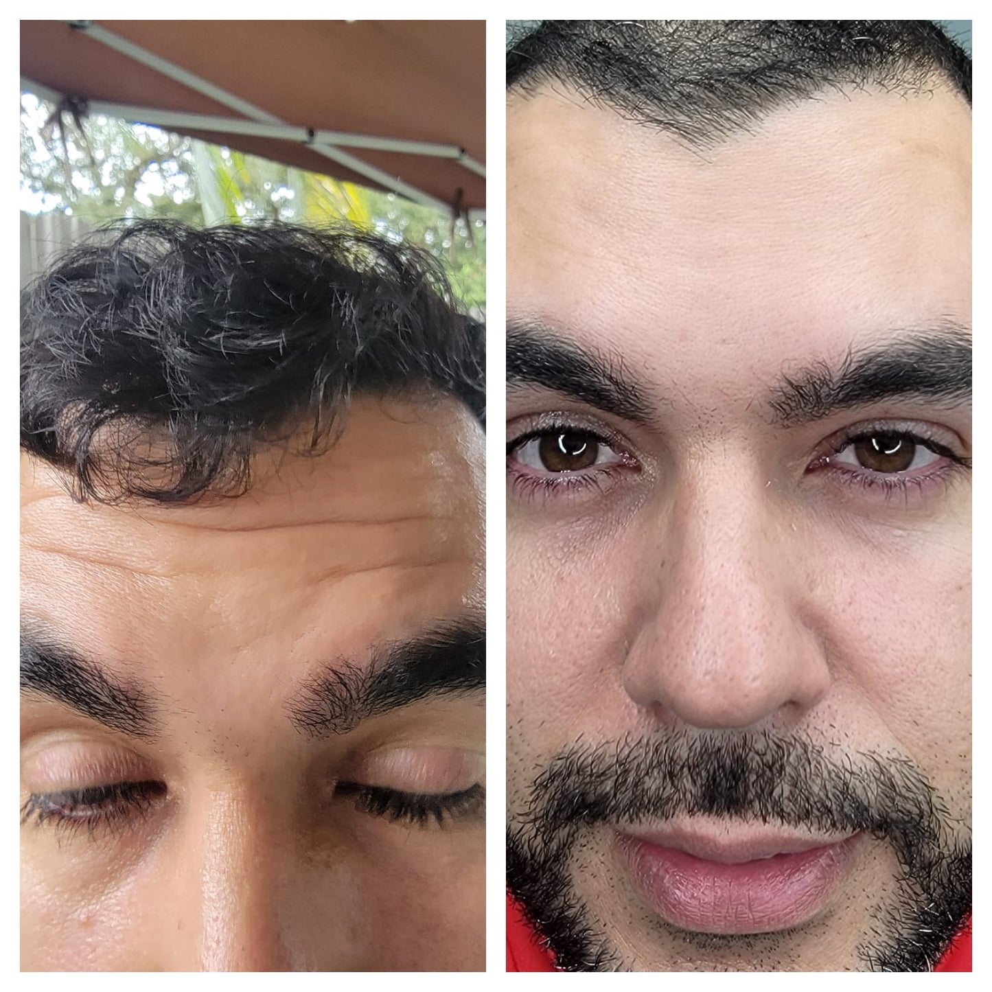 Cosmetic Botox.   BEFORE AND AFTER