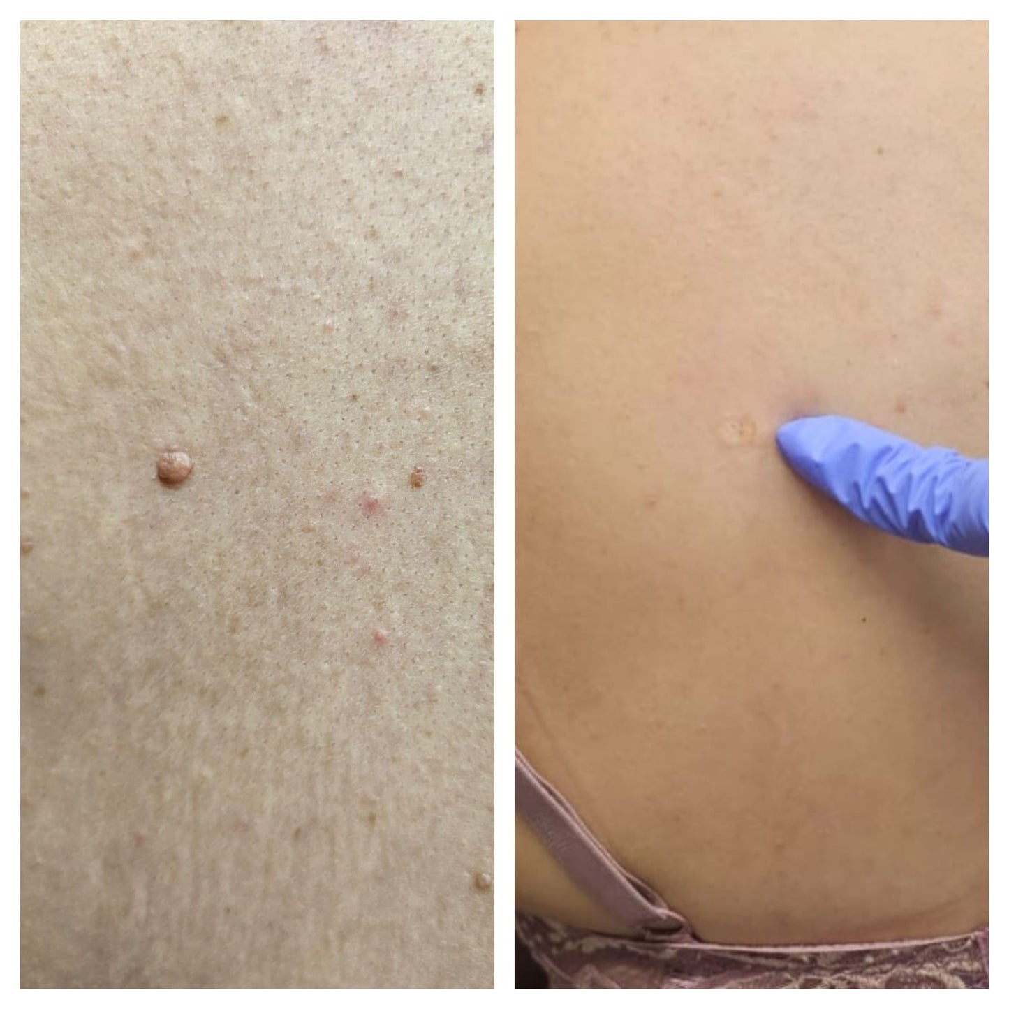 Electrocautery  BEFORE AND AFTER