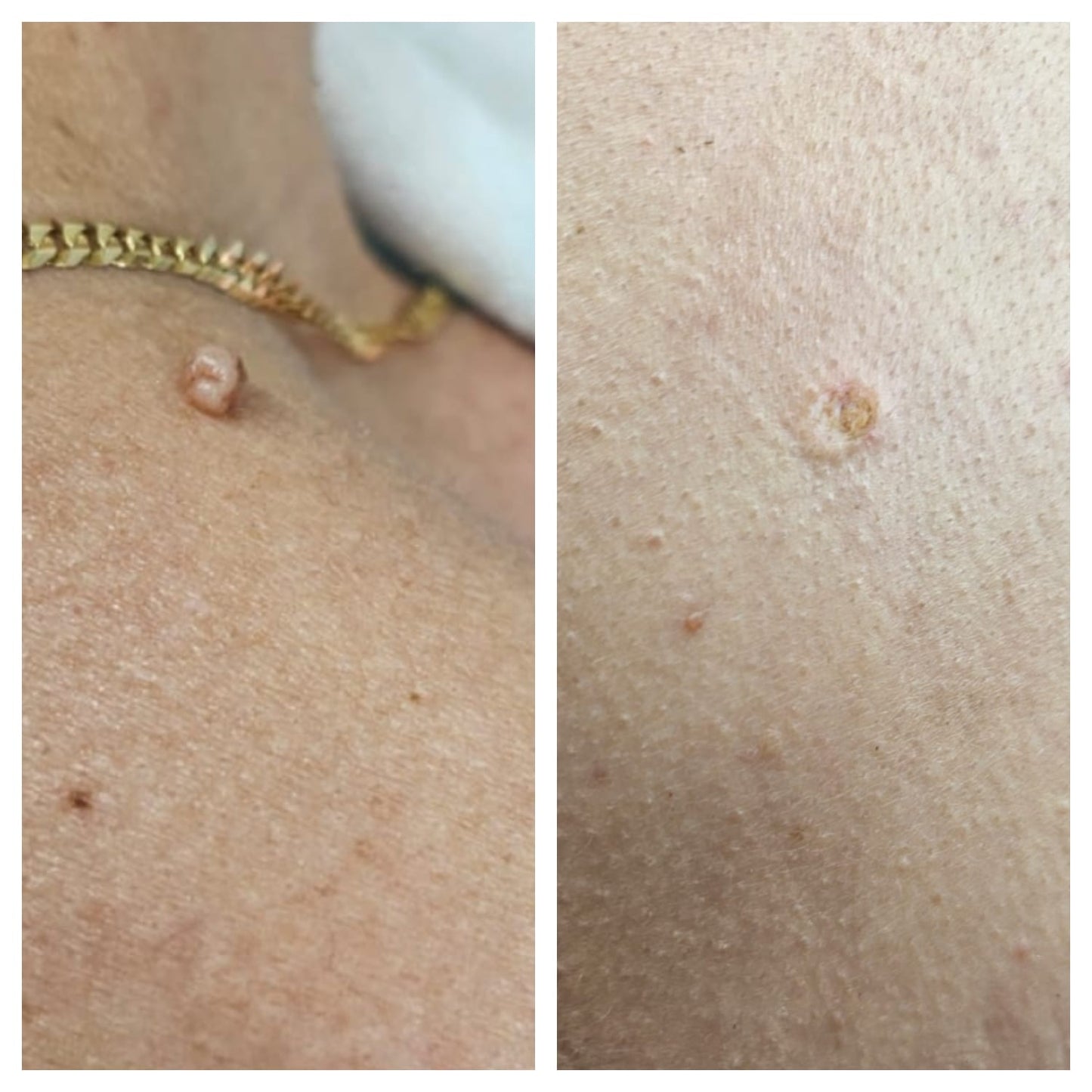 Electrocautery  BEFORE AND AFTER