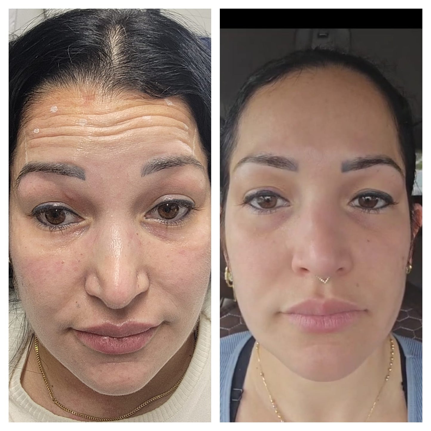 Cosmetic Botox.   BEFORE AND AFTER