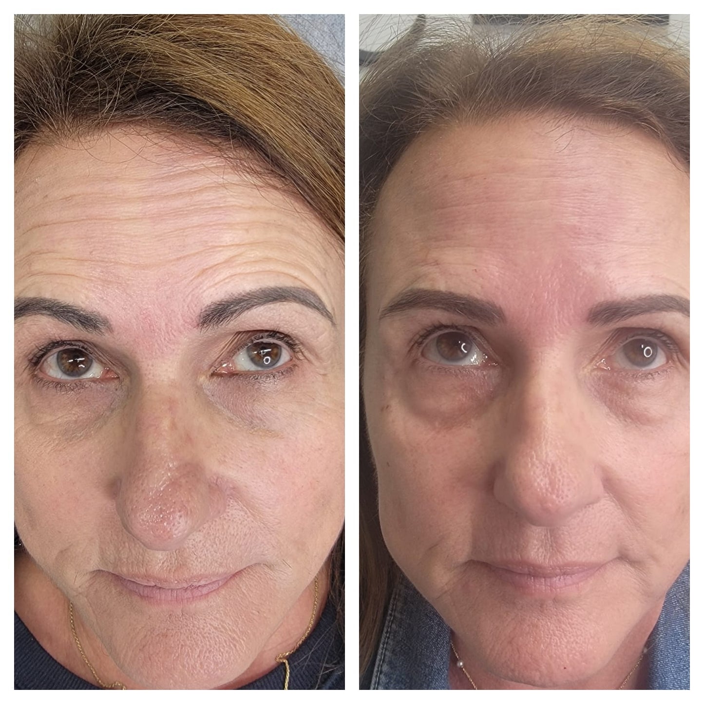 Cosmetic Botox.   BEFORE AND AFTER