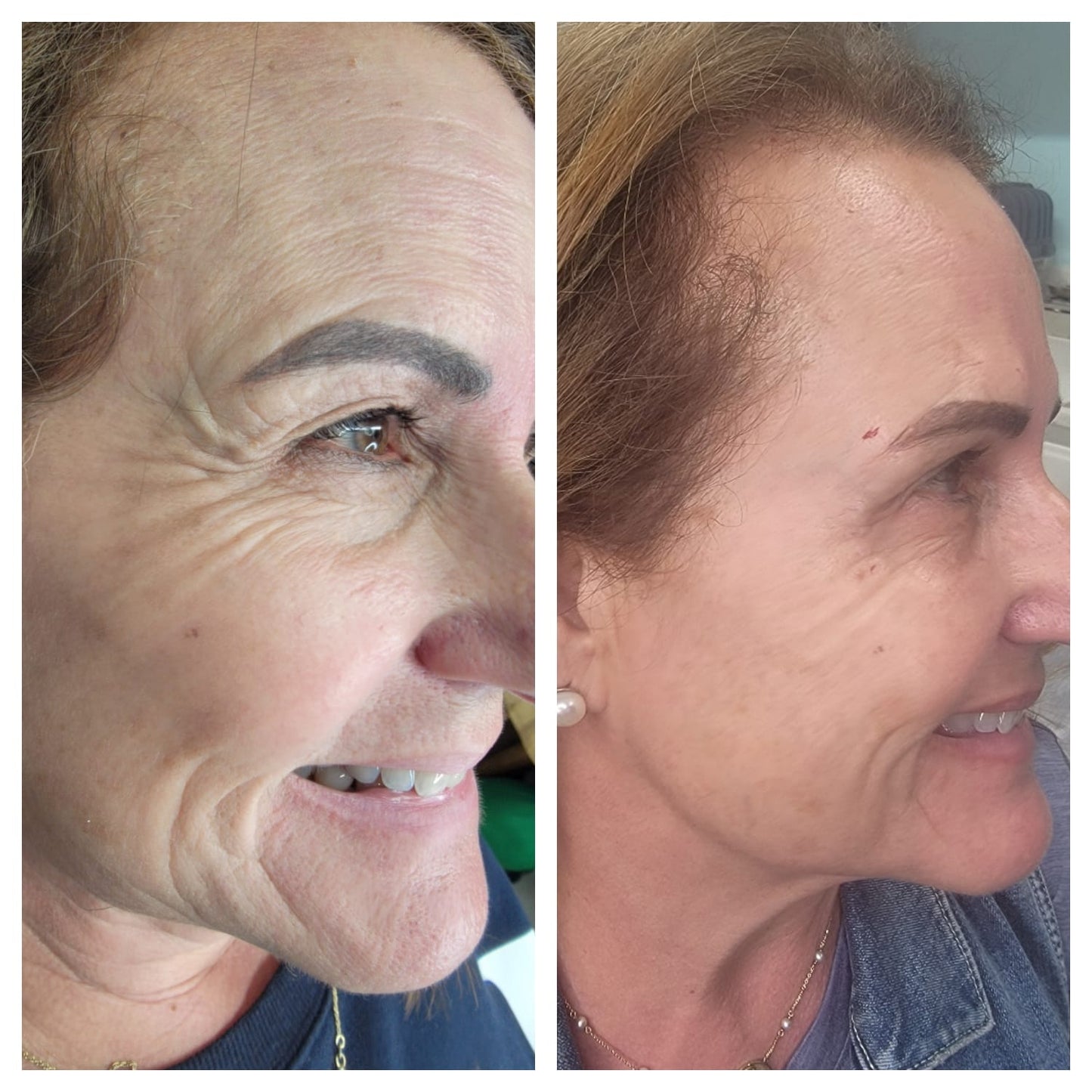 Cosmetic Botox.   BEFORE AND AFTER