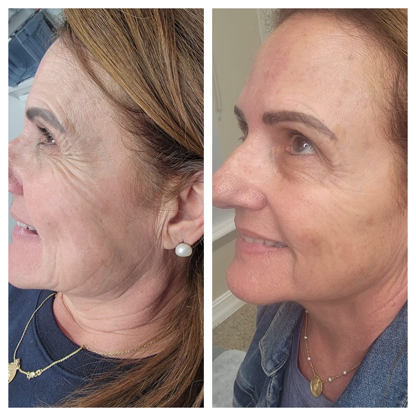 Cosmetic Botox.   BEFORE AND AFTER